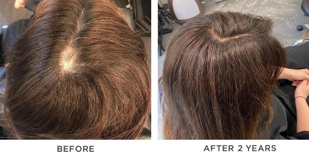 female patient hair loss | newdrugloft.com